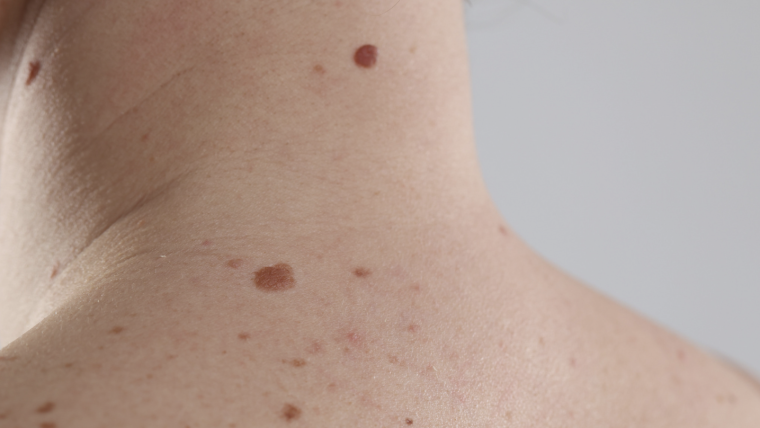 Dermatologist Visit for Full Body Skin Exam Near Alexandria, Virginia